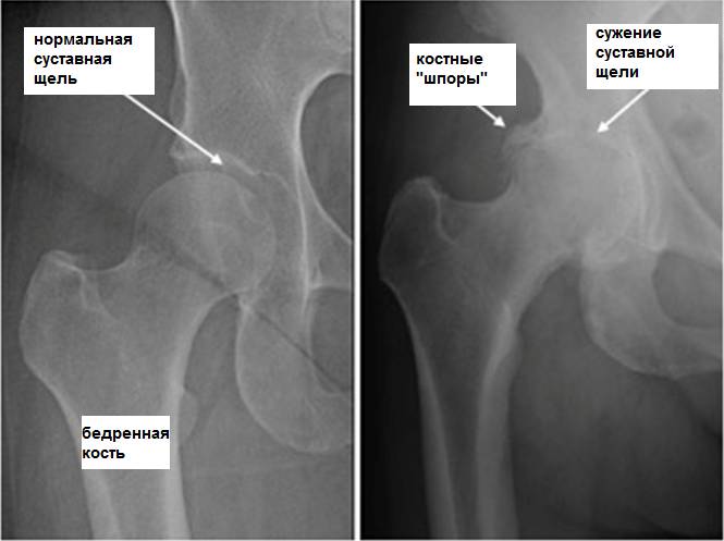 Болит спина и тазобедренный сустав при беременности