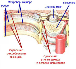 Болит спина в области ребер справа при движении