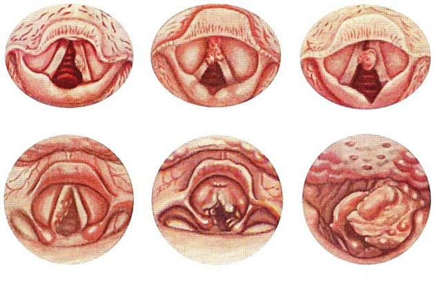 Рак горла может вызвать боль с одной стороны
