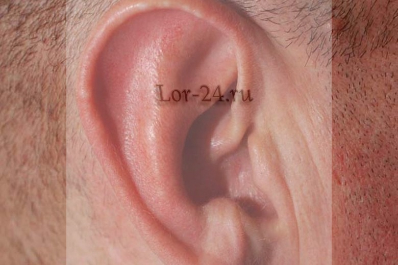 Воспаление хряща ушной раковины